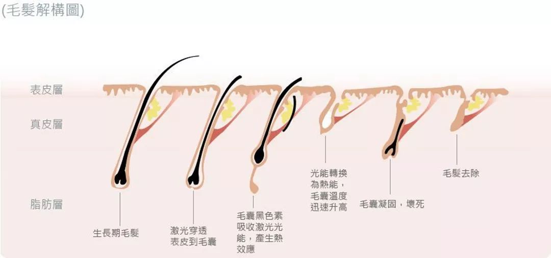 “白煮蛋”與“獼猴桃”之間，還差一個(gè)它 強(qiáng)脈沖脫毛器械，值得買(mǎi)嗎？